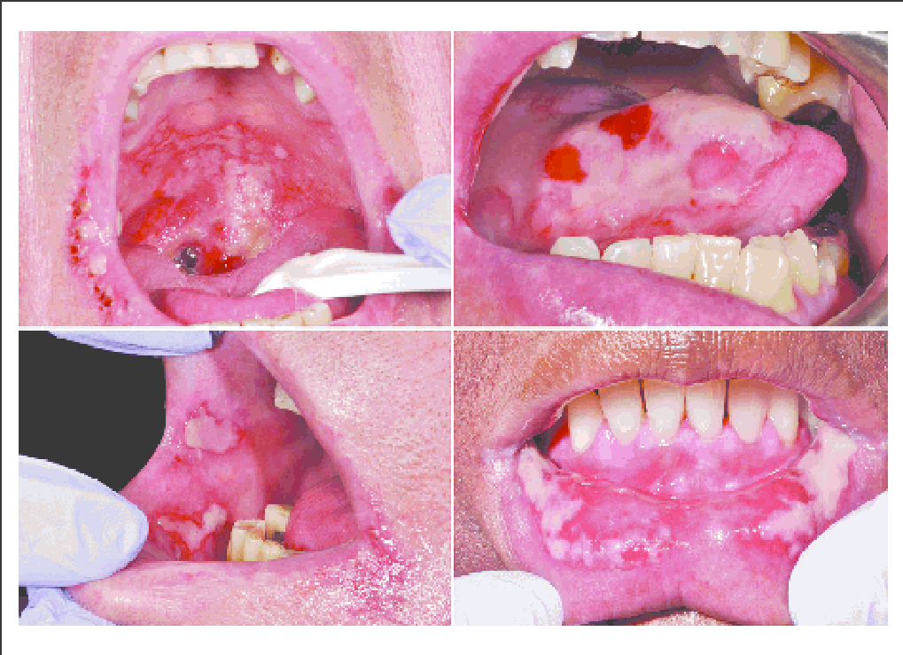 Symptoms of Oral Mucositis