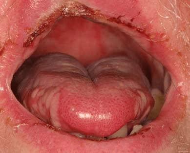 oral mucositis: symptoms