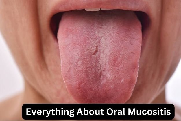 Oral Mucositis