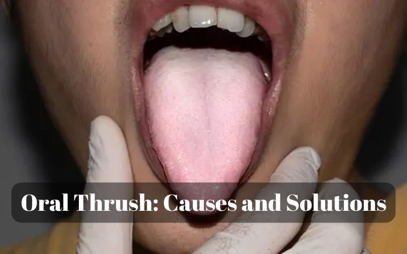 Oral Thrush