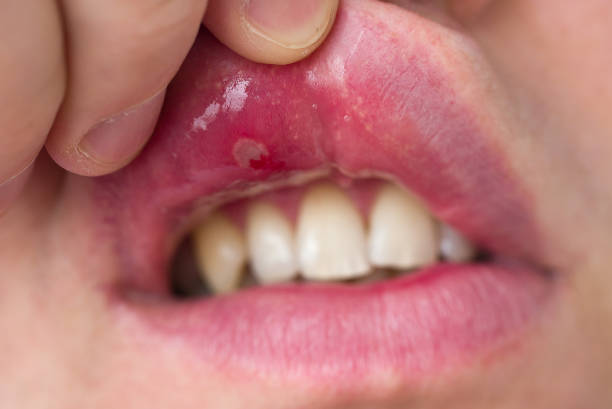 mouth ulcer causes