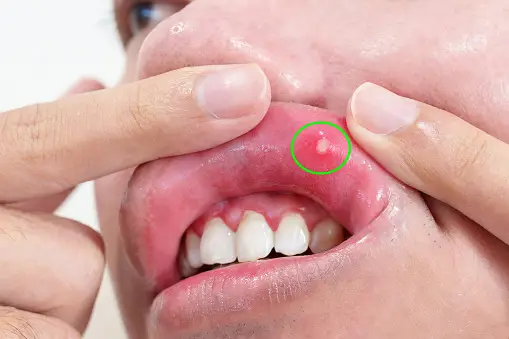 Mouth ulcers home remedies