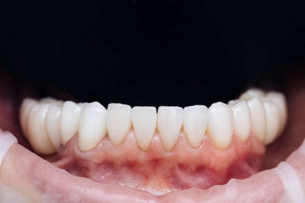 stains on teeth